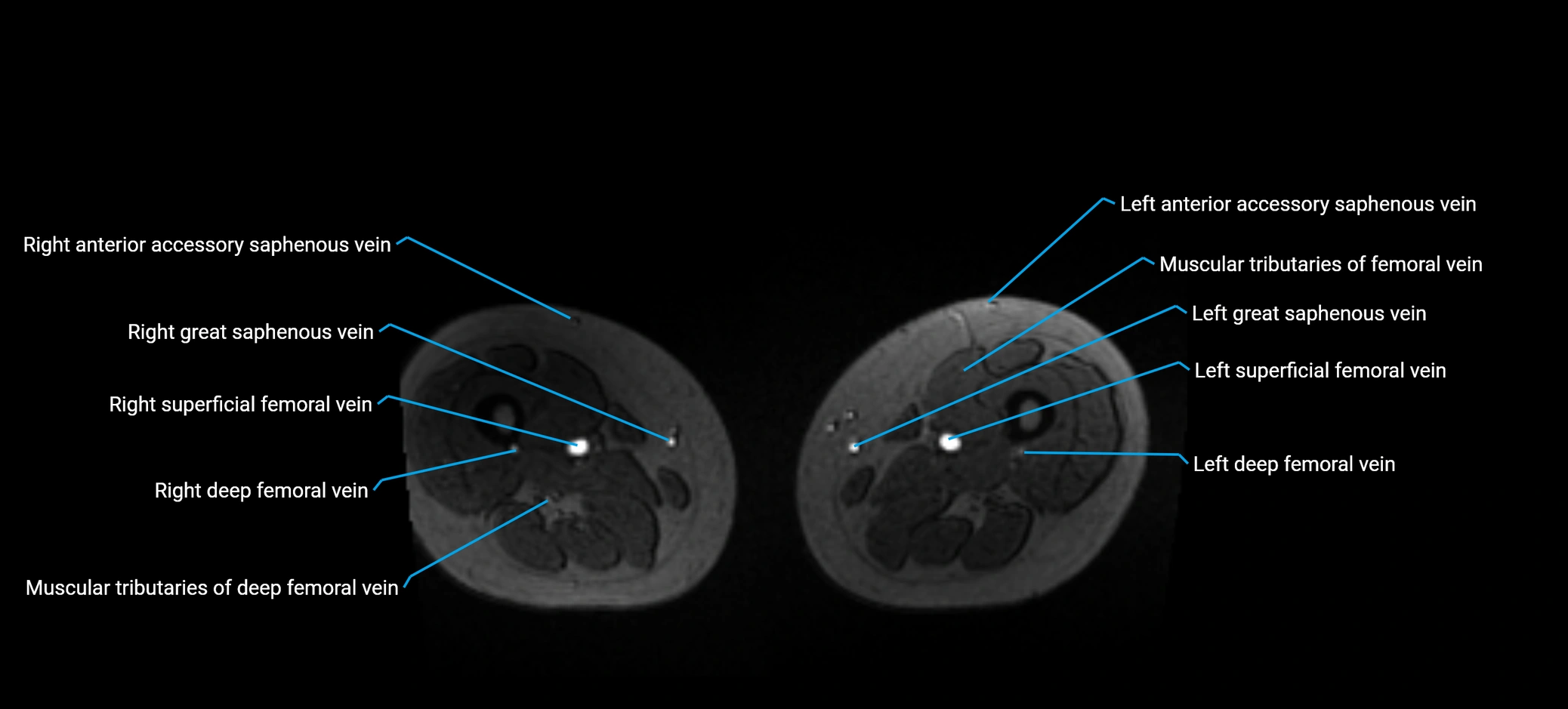 MRV abdomen pelvis & lower limb axial cross sectional anatomy labelled MRI image 288 (1).webp